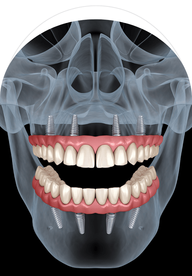X-ray view of full mouth dental implants – All-on-4 and All-on-6