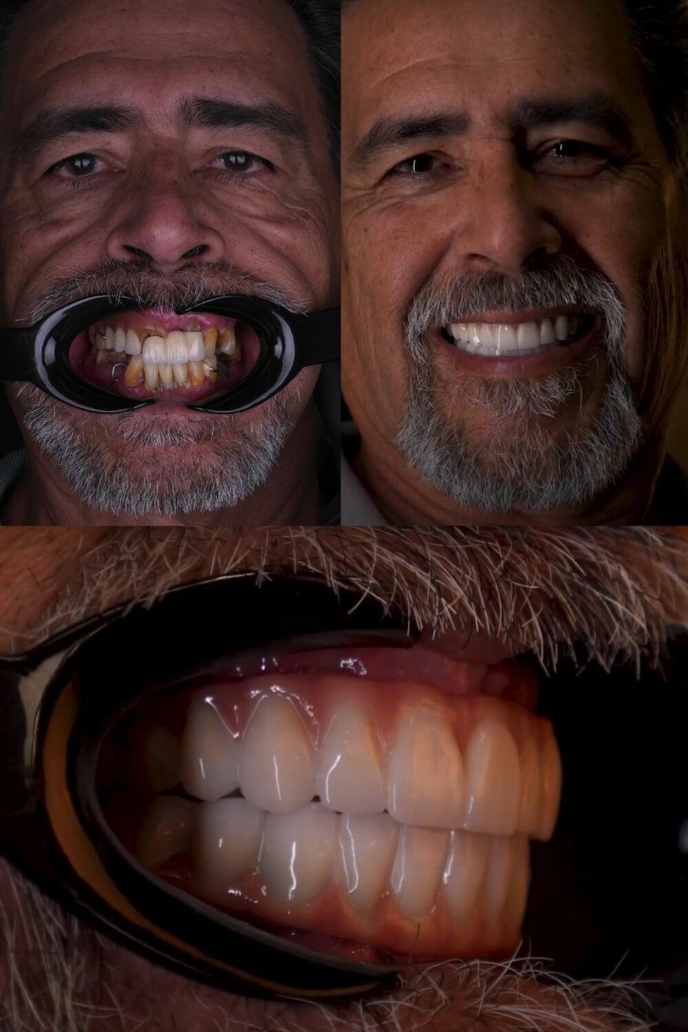 Full arch restoration before and after using All-on-4 dental implants at EnamelDent Tijuana