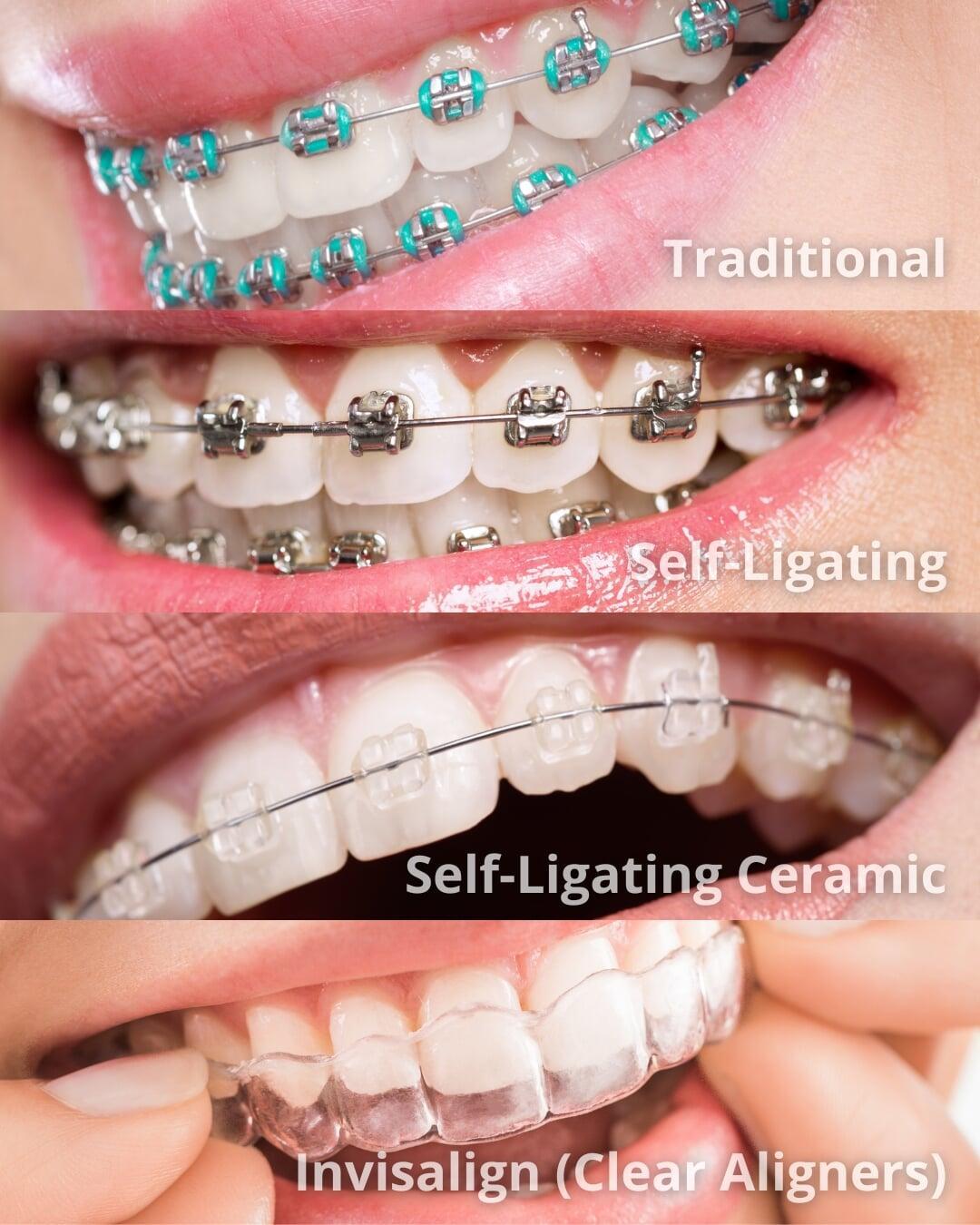 Types of dental braces include metal braces, ceramic braces, self-ligating braces, lingual braces, and clear aligners.