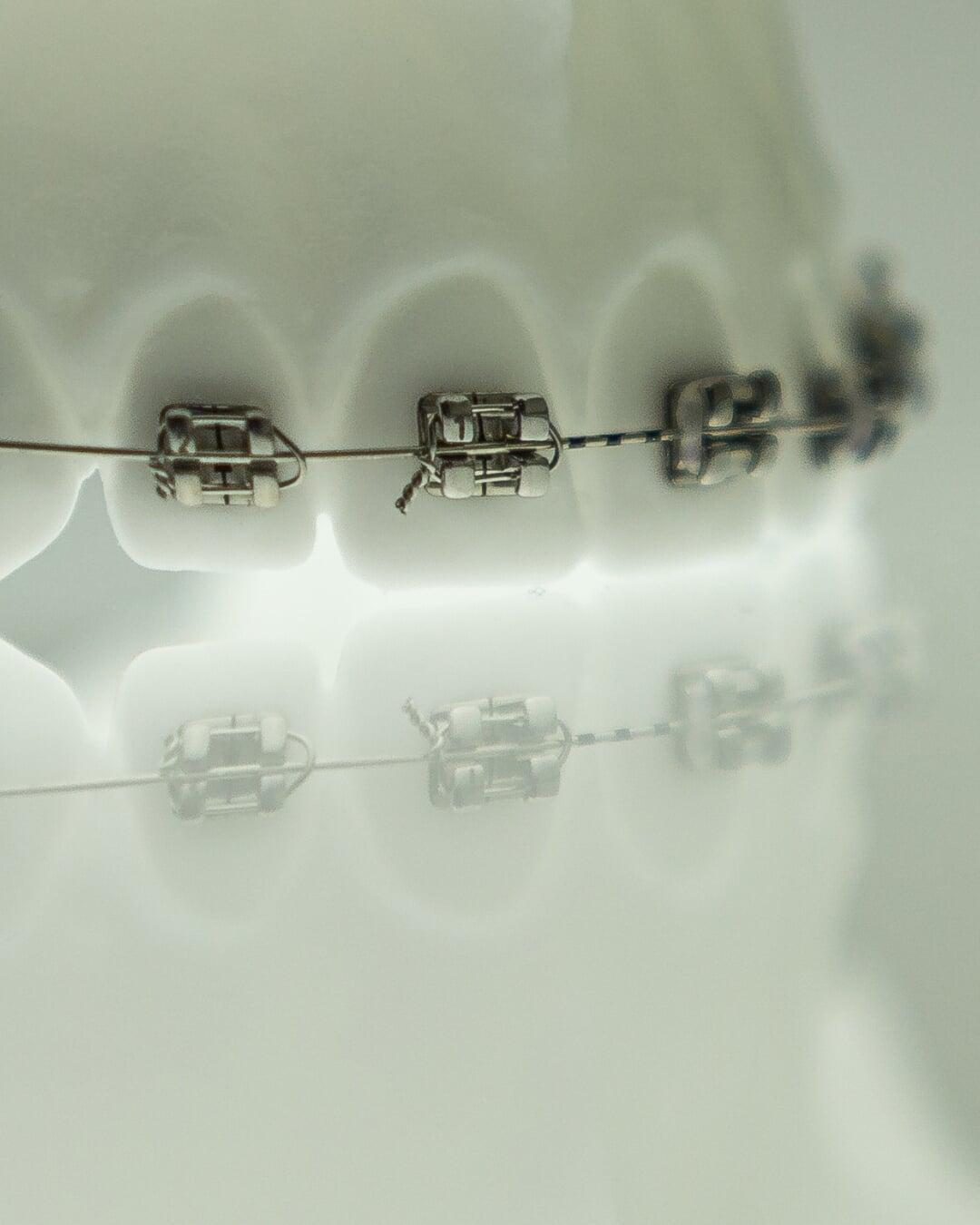 Self-ligating braces that align teeth efficiently using advanced brackets without elastic ties.