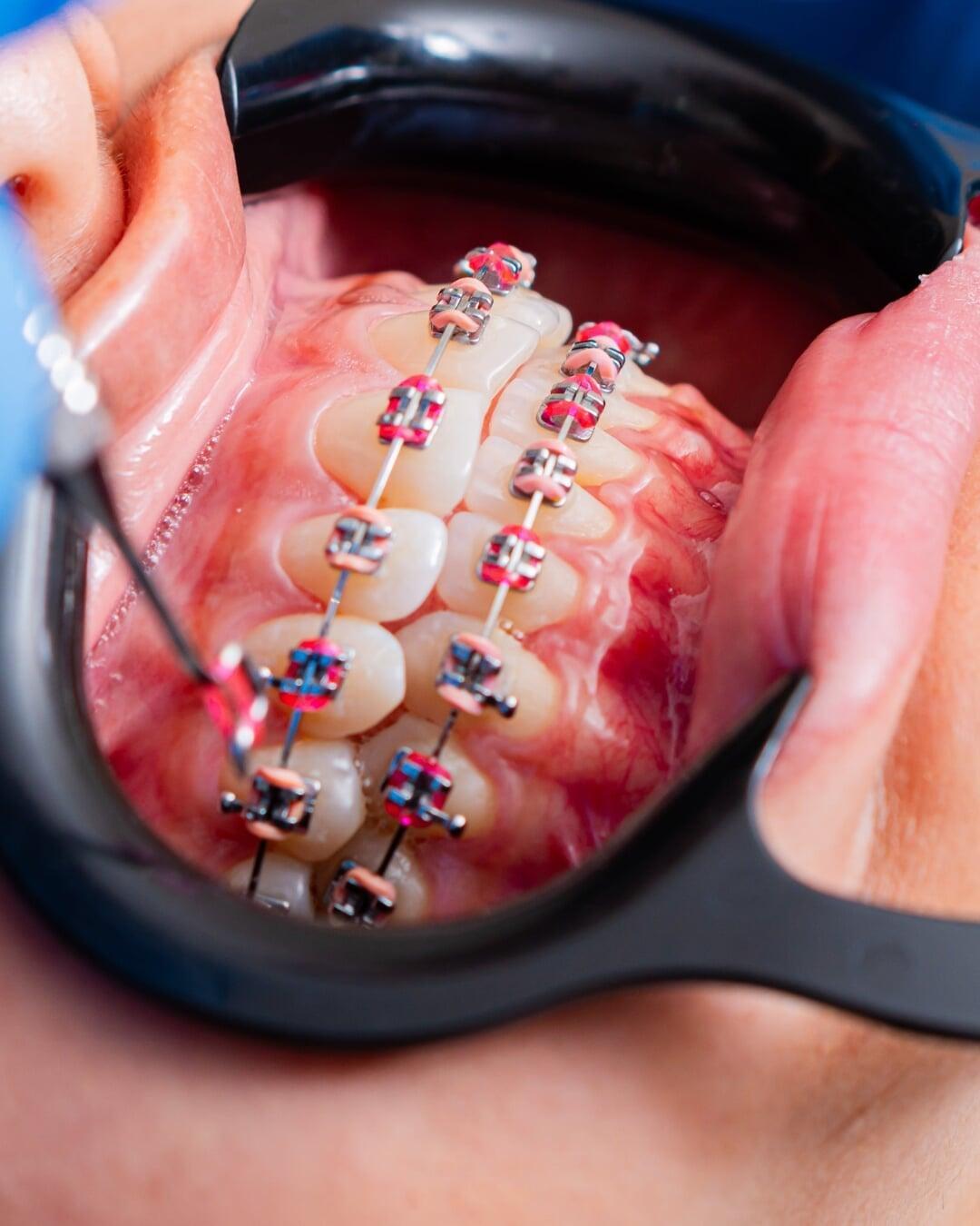 Orthodontic braces used to align teeth, correct bite problems, and enhance overall smile appearance.