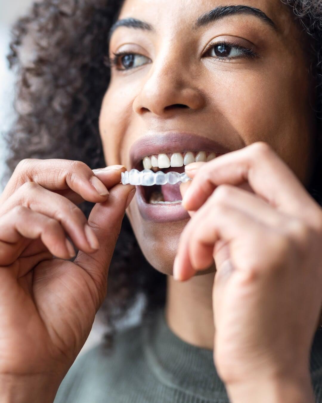 Invisalign clear aligners that gently straighten teeth using custom, removable trays for a discreet orthodontic treatment.