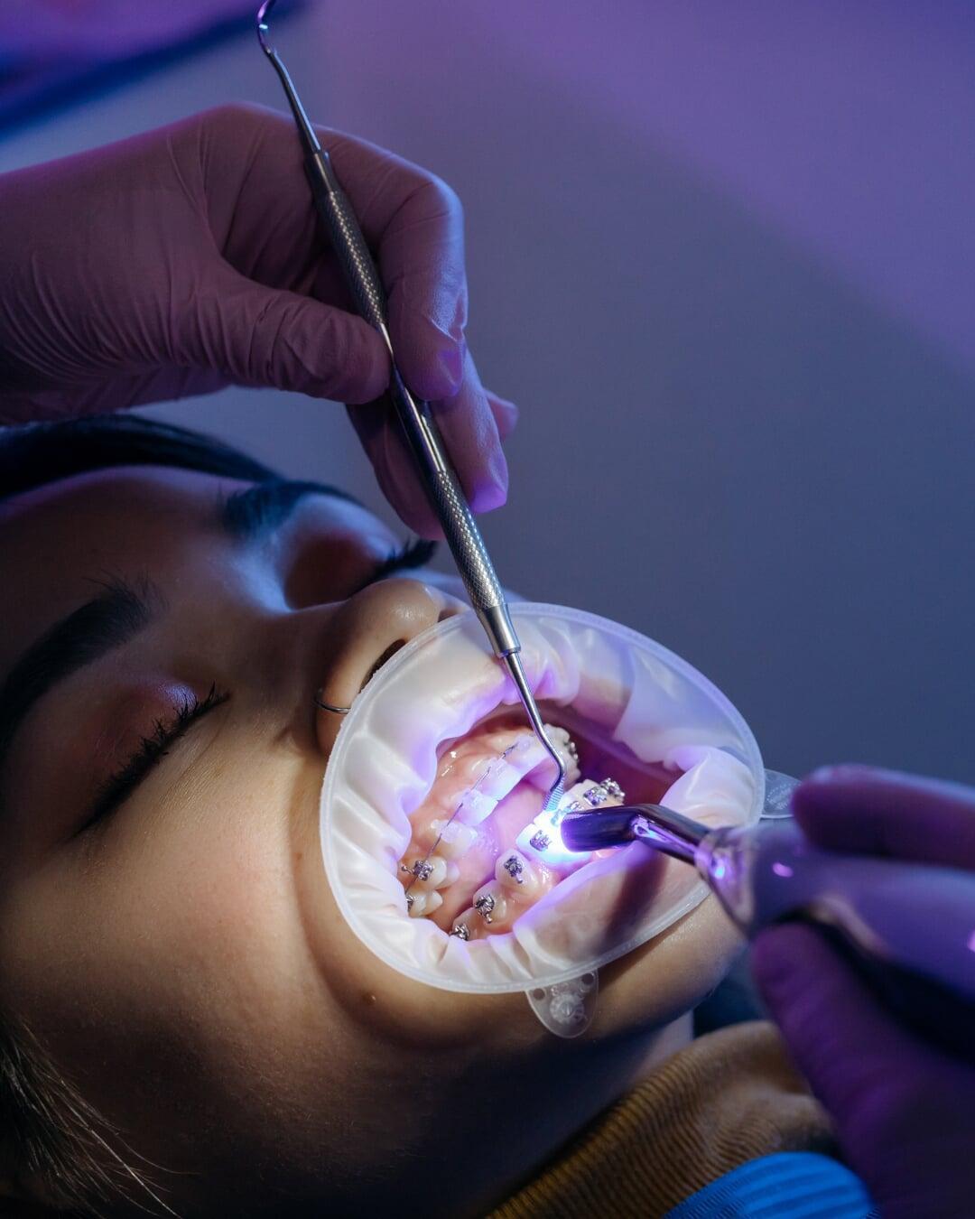 Dental braces used to straighten teeth and correct bite alignment, improving function and smile aesthetics.