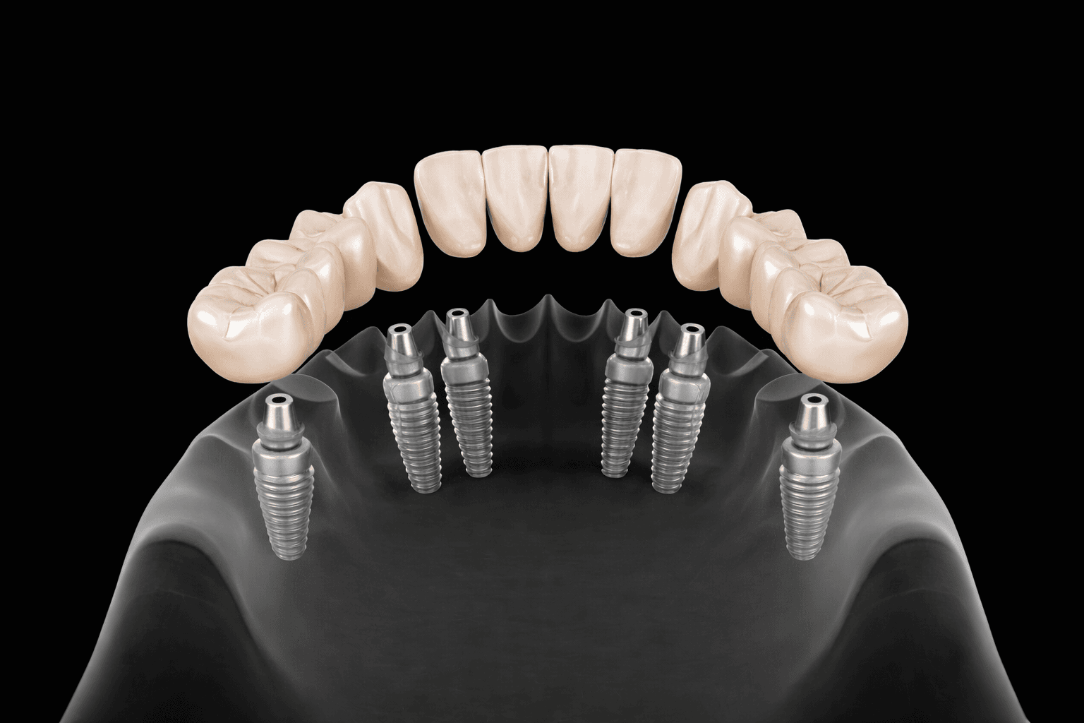 3 on 6 dental implants illustration showing three bridge sections supported by six implants for full arch restoration