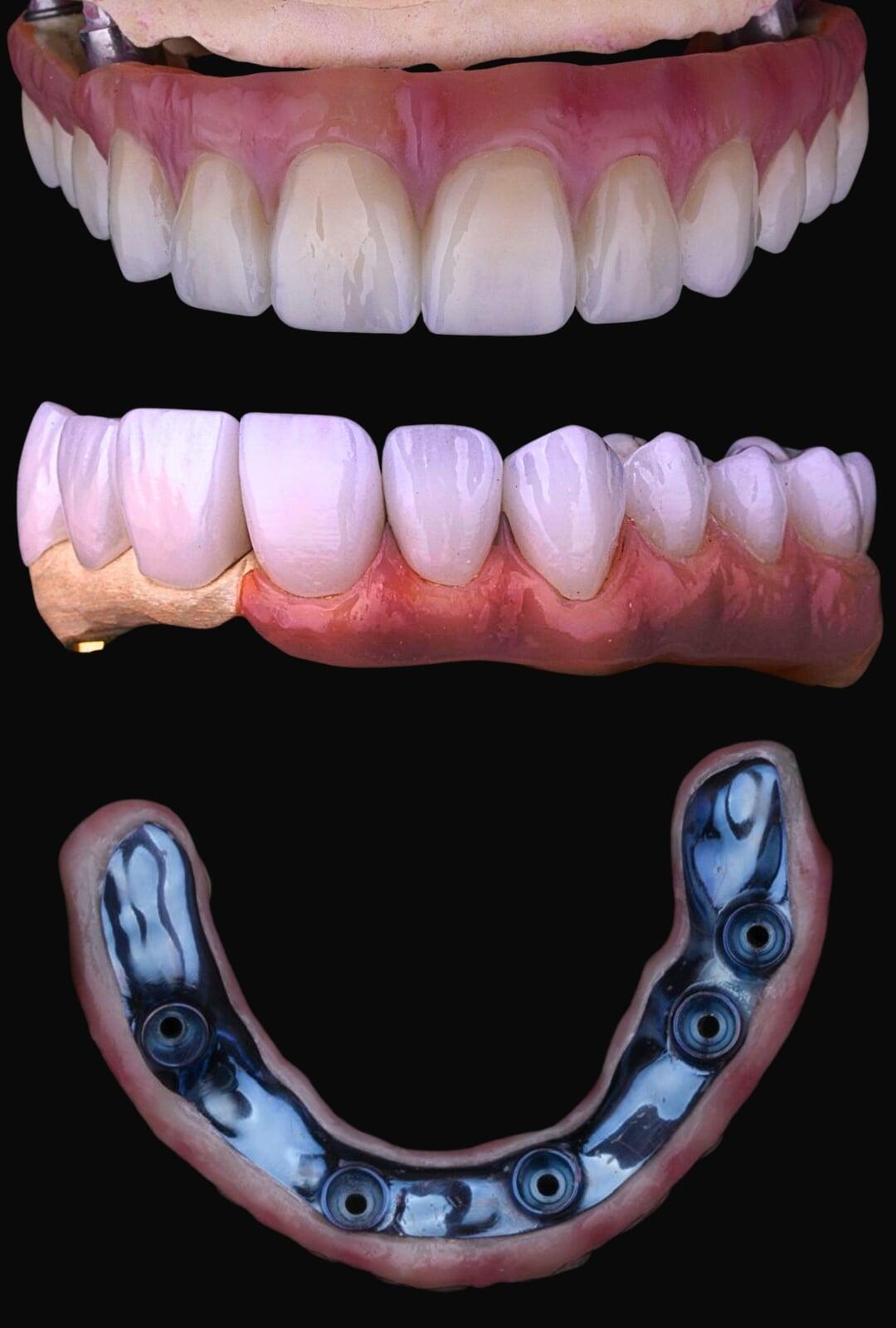 Full arch dental implant prosthesis with zirconia teeth and titanium bar shown in layered view for implant-supported smile restoration