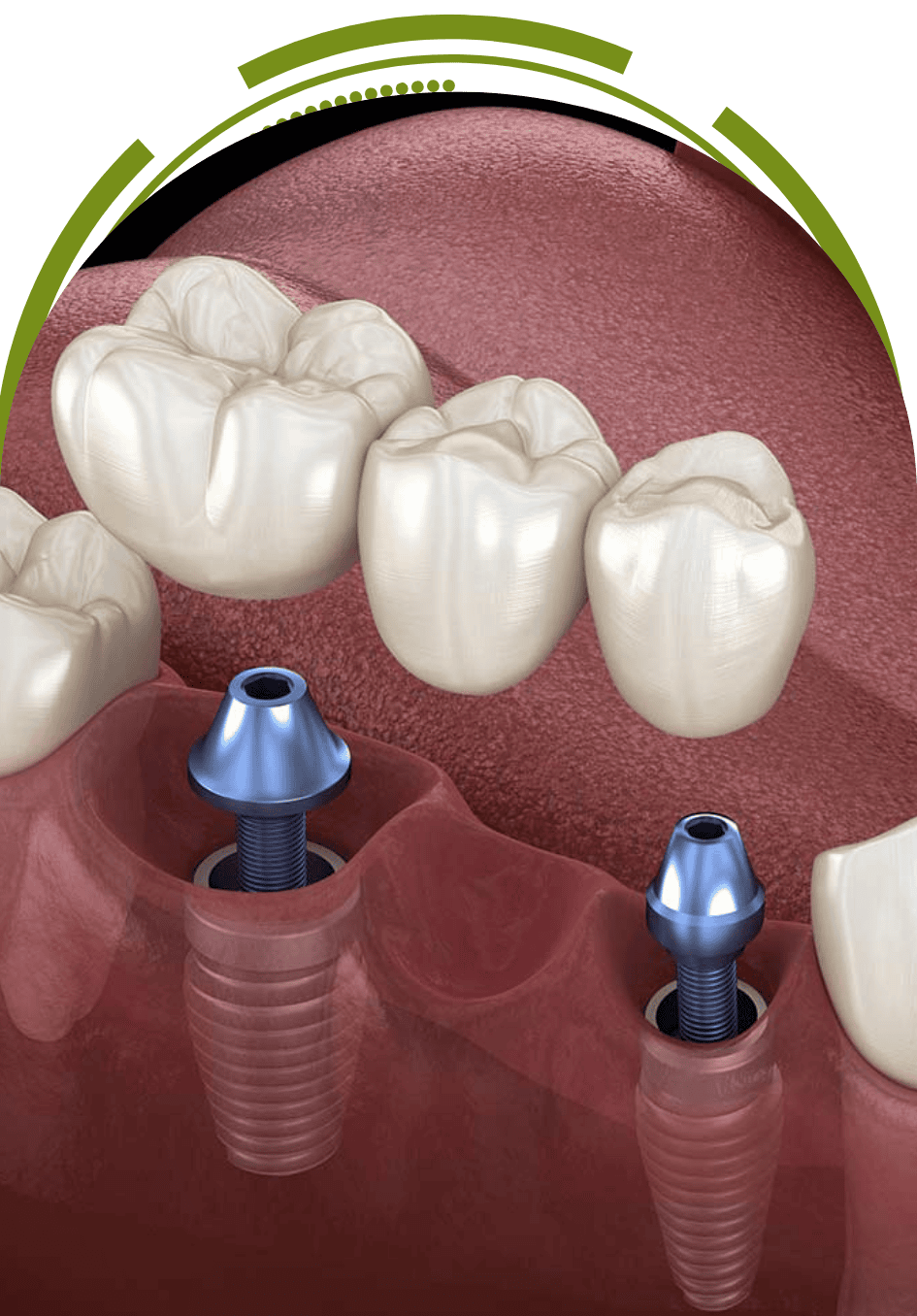 Trilor DentuDental implant bridge supported by two titanium implants to replace multiple missing teeth – EnamelDent  Implant Tijuana