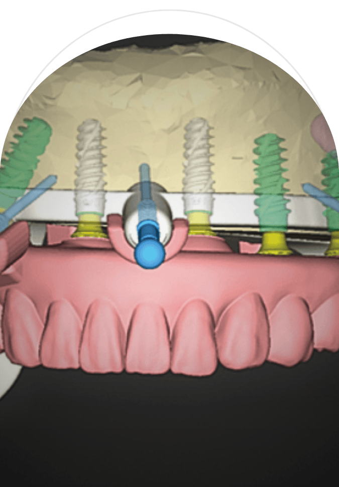 Digital planning of All-on-4 dental implants using guided surgery system