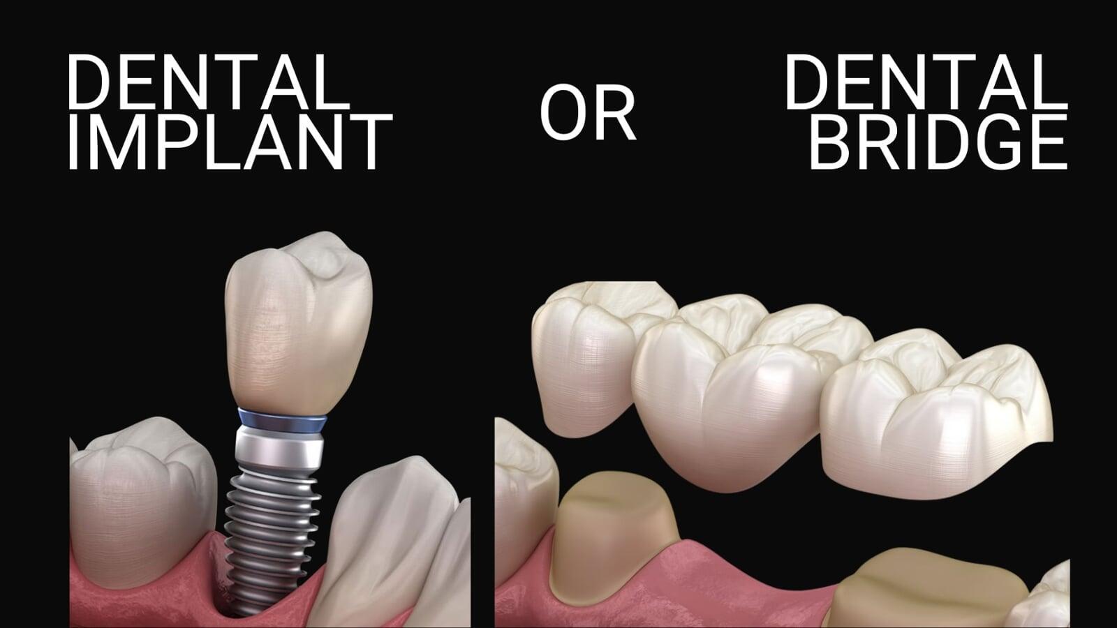 Dental implant vs dental bridge – illustrated comparison of tooth replacement options