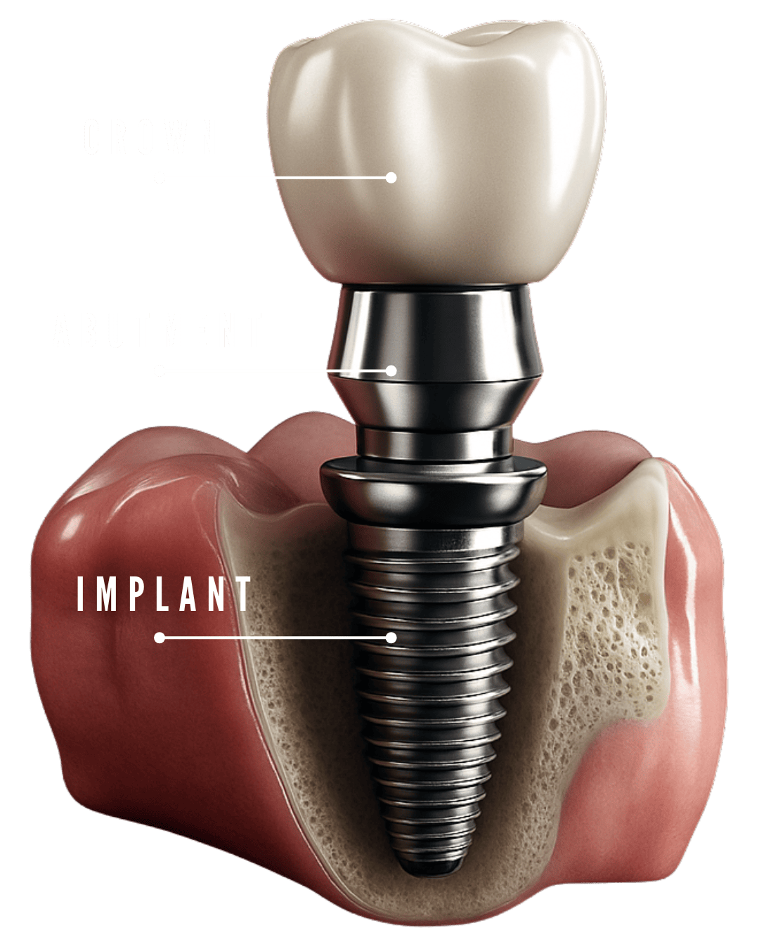 3D dental implant diagram with labels highlighting crown, abutment, screw, and titanium post.