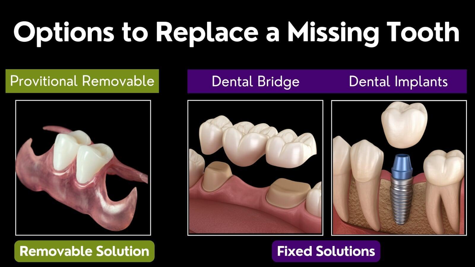 Comparison of provisional teeth, dental bridges, and dental implants.