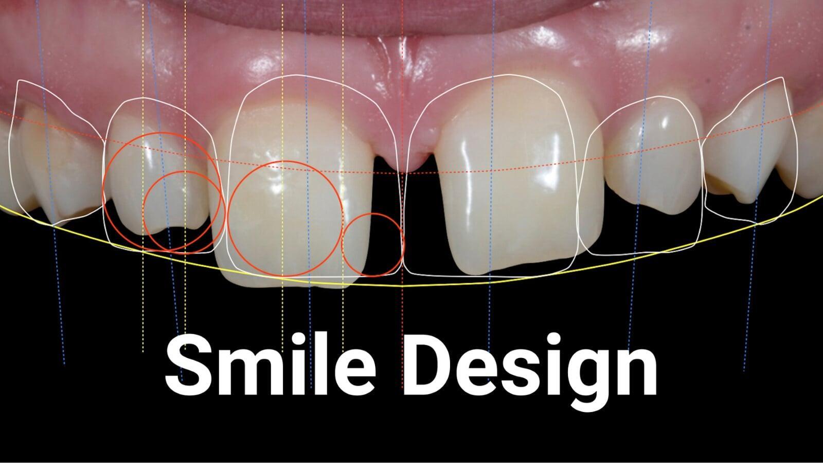 Smile design digital planning with facial and dental proportions for aesthetic restoration