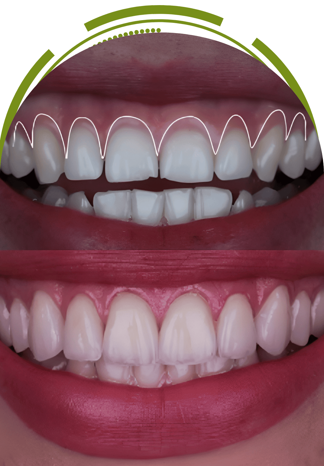 Trilor Dentures