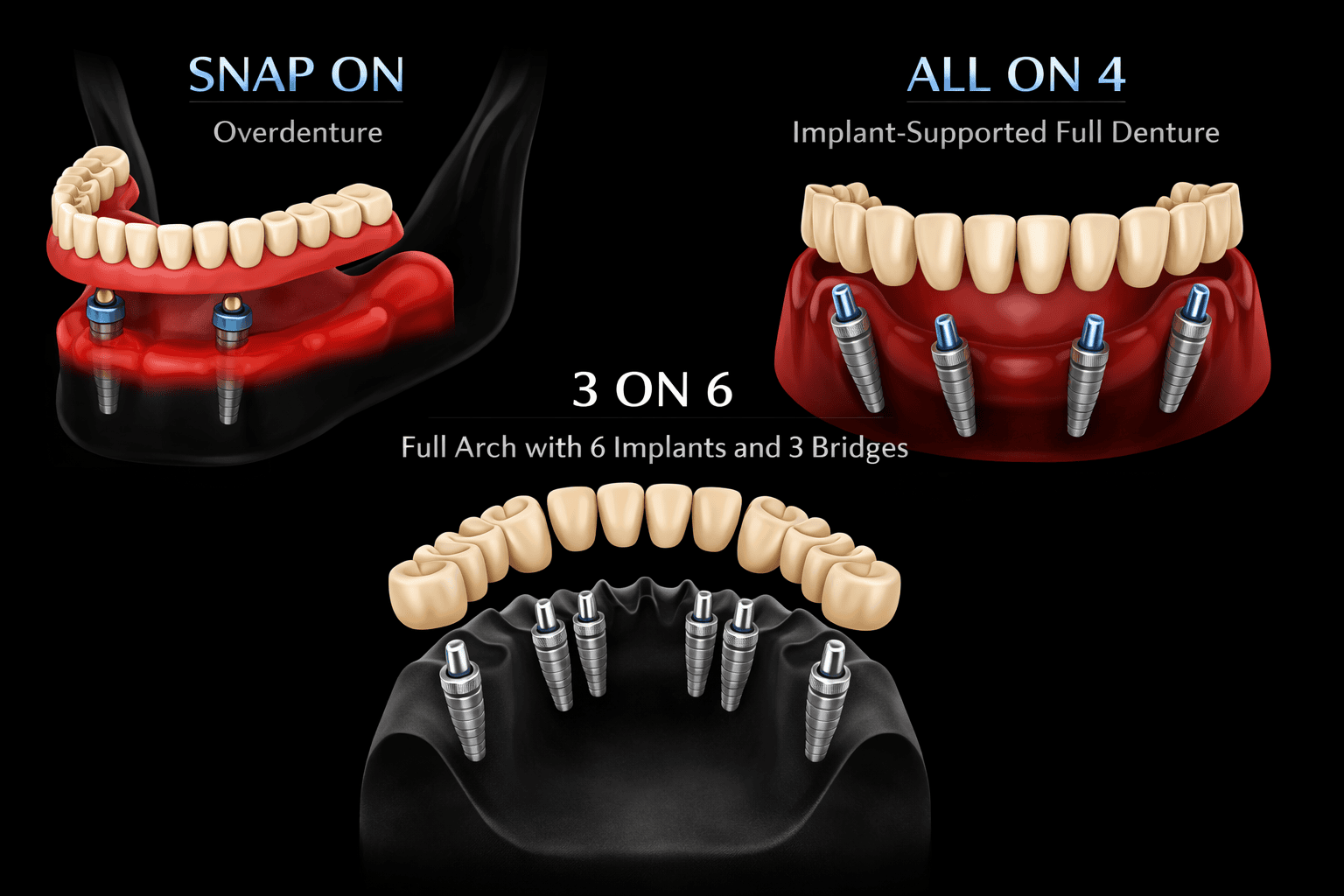 Comparison of Snap On, All on 4, and 3 on 6 dental implant options for full mouth tooth replacement.