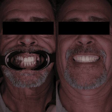 Same-day temporary full arch dental implants – fixed teeth in one visit | EnamelDent EnamelDent All on 4 Tijuana