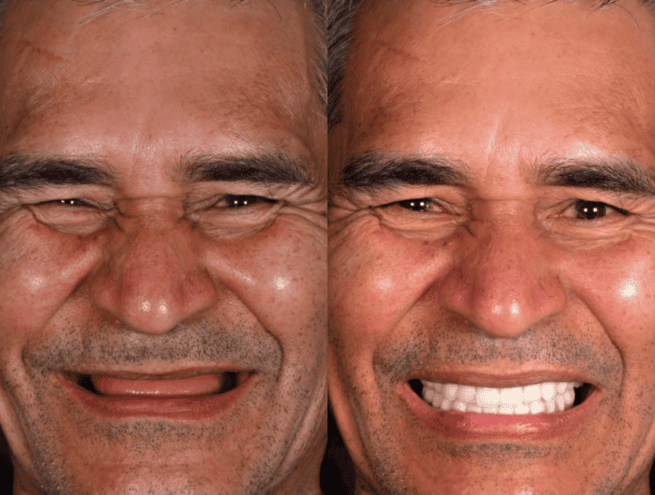 Before and after photo of male patient treated with All-on-4 dental implants – full arch restoration with fixed teeth