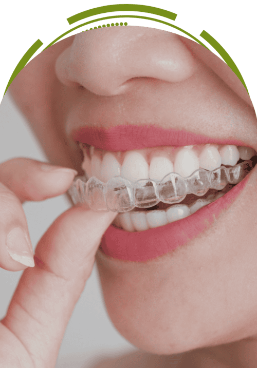 Woman placing clear aligner on teeth – invisible orthodontic treatment with Invisalign 
